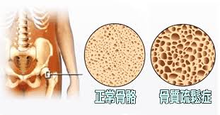無聲的小偷骨質疏鬆症，忽視骨折的風險